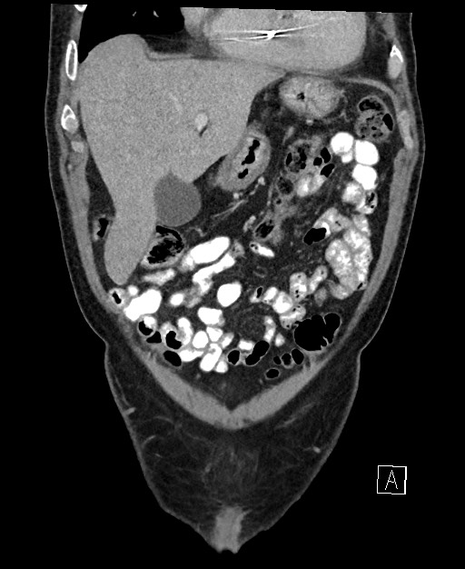 Active lower gastrointestinal bleeding - diverticular (Radiopaedia 61203-69106 Coronal C+ portal venous phase 36).jpg
