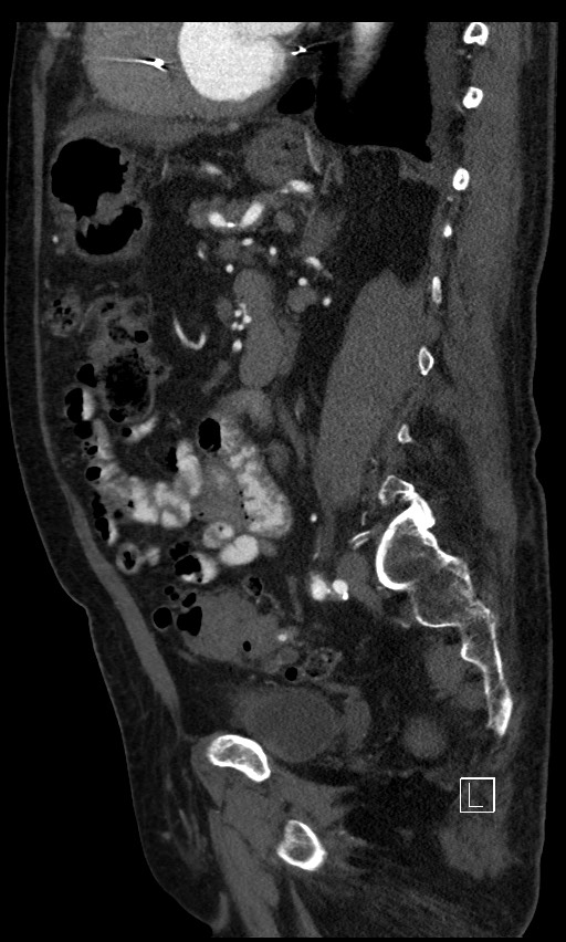Active lower gastrointestinal bleeding - diverticular (Radiopaedia 61203-69106 Sagittal C+ arterial phase 65).jpg