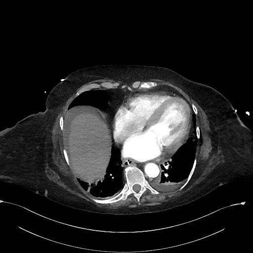 Active renal extravasation with large subcapsular and retroperitoneal hemorrhage (Radiopaedia 60975-68796 Axial C+ arterial phase 17).jpg