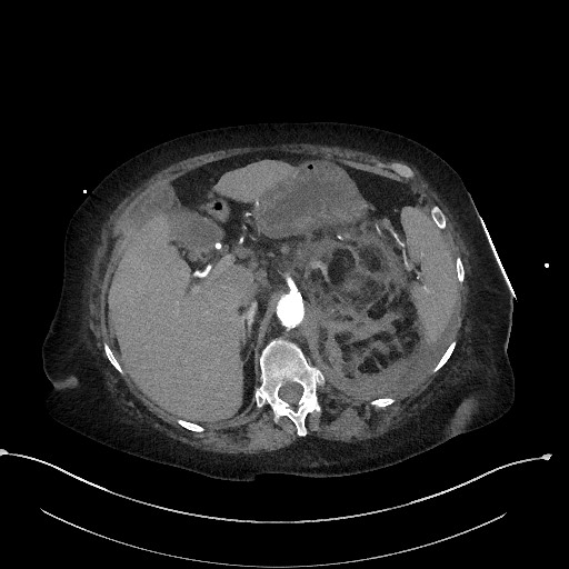 Active renal extravasation with large subcapsular and retroperitoneal hemorrhage (Radiopaedia 60975-68796 Axial C+ arterial phase 55).jpg