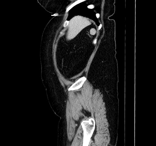 Acute appendicitis, heterotaxy syndrome (Radiopaedia 66884-76202 Sagittal C+ portal venous phase 27).jpg