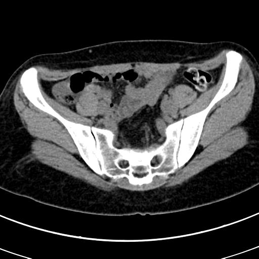 Acute appendicitis (Radiopaedia 30261-30888 Axial non-contrast 77).jpg