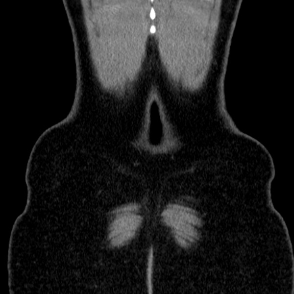 Acute appendicitis (Radiopaedia 38255-40270 Coronal C+ portal venous phase 86).jpg