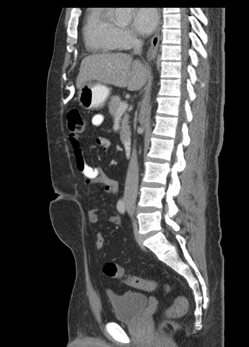 Acute appendicitis (Radiopaedia 48511-53463 Sagittal C+ portal venous phase 70).jpg