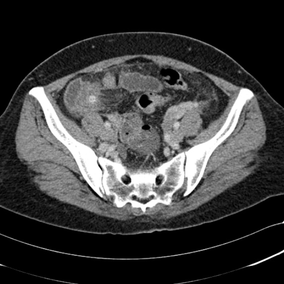 File:Acute appendicitis (Radiopaedia 48792-53822 Axial C+ portal venous phase 90).jpg