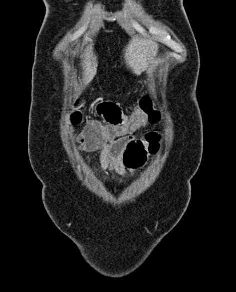 File:Acute appendicitis (Radiopaedia 48792-53822 Coronal C+ portal venous phase 37).jpg