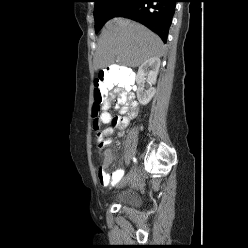 File:Acute appendicitis (Radiopaedia 52672-58589 Sagittal C+ arterial phase 39).jpg