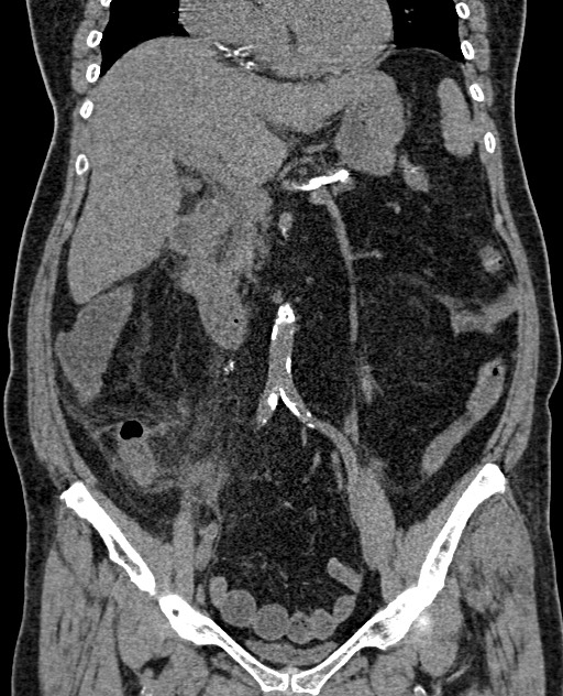 Acute appendicitis (Radiopaedia 58627-65818 Coronal non-contrast 38).jpg