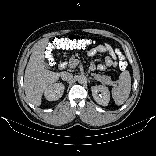 Acute appendicitis (Radiopaedia 84780-100240 Axial C+ delayed 33).jpg