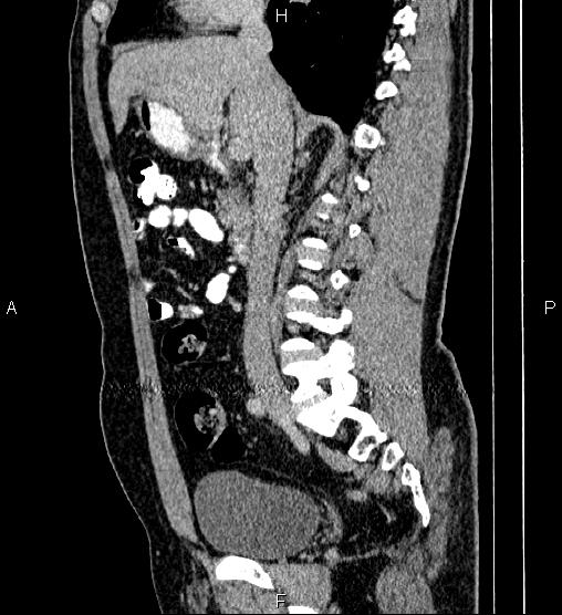 File:Acute appendicitis (Radiopaedia 84780-100240 Sagittal C+ portal venous phase 44).jpg