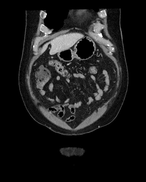 Acute appendicitis - large appendicoliths (Radiopaedia 61805-69820 Coronal C+ portal venous phase 29).jpg
