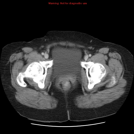 Acute appendicitis complicated by ovarian vein thrombophlebitis (Radiopaedia 16172-15851 Axial C+ portal venous phase 84).jpg