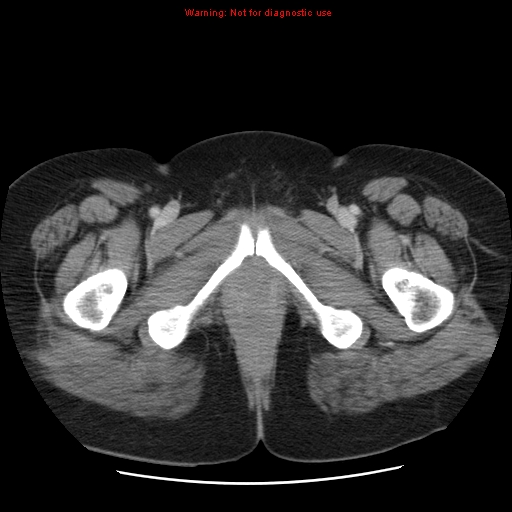 Acute appendicitis complicated by ovarian vein thrombophlebitis (Radiopaedia 16172-15851 Axial C+ portal venous phase 91).jpg
