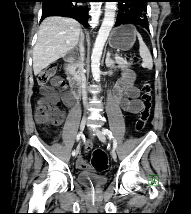 Acute arterial mesenteric ischemia (Radiopaedia 78238-90828 Coronal C+ portal venous phase 55).jpg