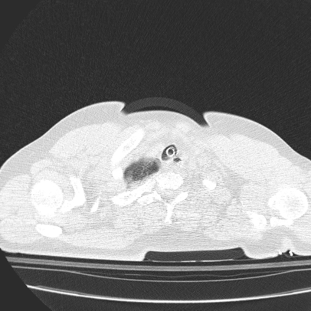 Acute aspiration pneumonitis (Radiopaedia 33605-34703 Axial lung window 12).jpg
