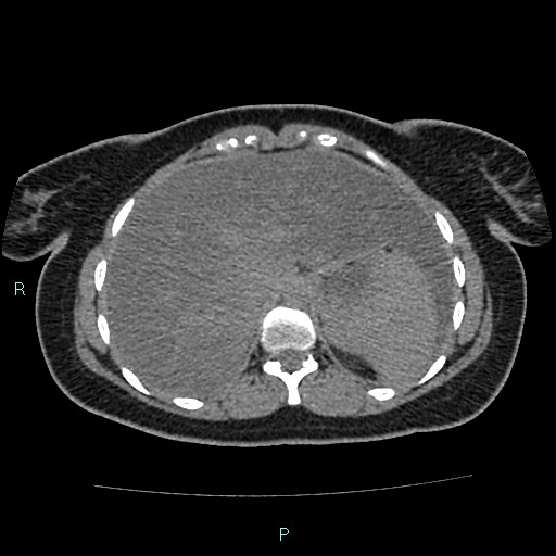 Acute bilateral pyelonephritis (Radiopaedia 37146-38881 Axial non-contrast 20).jpg