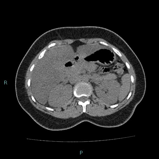 Acute bilateral pyelonephritis (Radiopaedia 37146-38881 Axial non-contrast 36).jpg