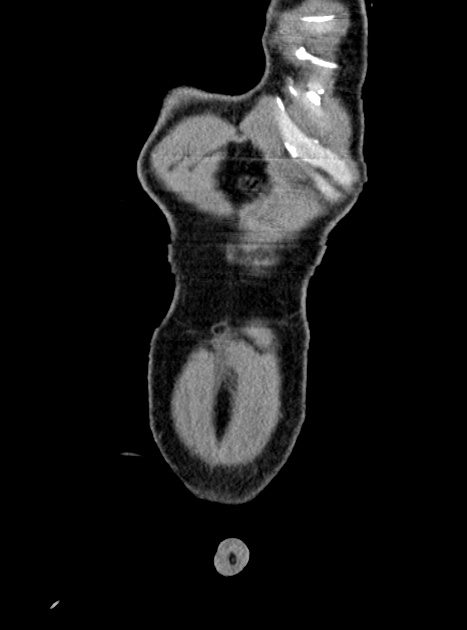 Acute bowel ischemia (Radiopaedia 87695-104114 Coronal C+ portal venous phase 66).jpg
