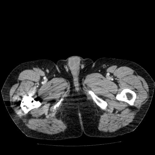 File:Acute cholecystitis and incidental left sided IVC (Radiopaedia 49352-54459 Axial C+ portal venous phase 174).jpg
