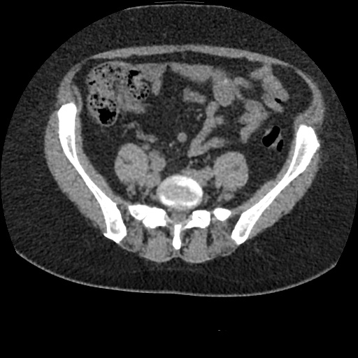 File:Acute cholecystitis and ureteric colic (Radiopaedia 42330-45444 Axial prone 73).jpg