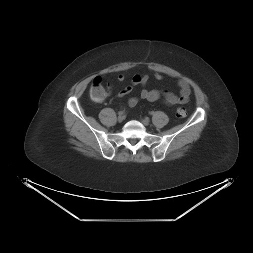 Acute cholecystitis with tensile fundus sign (Radiopaedia 71394-81723 Axial non-contrast 82).jpg
