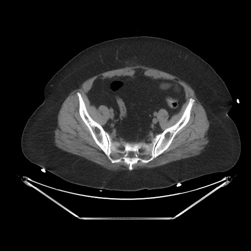 File:Acute cholecystitis with tensile fundus sign (Radiopaedia 71394-81723 Axial non-contrast 93).jpg