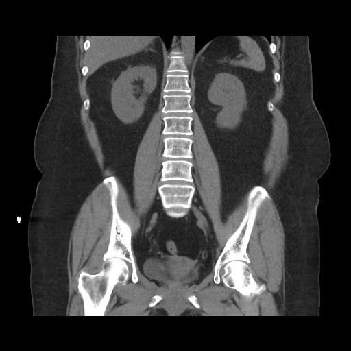 Acute cholecystitis with tensile fundus sign (Radiopaedia 71394-81723 Coronal non-contrast 80).jpg