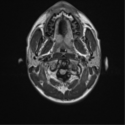 File:Acute disseminated encephalomyelitis (ADEM) (Radiopaedia 65319-74349 Axial FLAIR 1).png