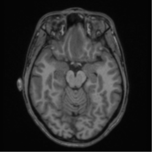 Acute disseminated encephalomyelitis (ADEM) (Radiopaedia 65319-74349 Axial T1 23).png