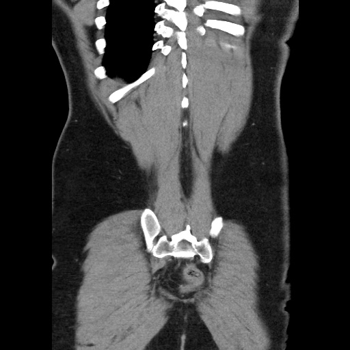 File:Acute diverticulitis with localized perforation (Radiopaedia 41296-44113 Coronal C+ portal venous phase 55).jpg