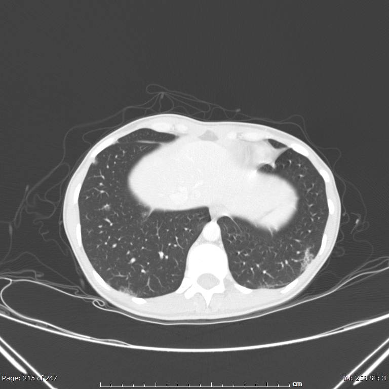 Acute eosinophilic pneumonia (Radiopaedia 48211-53073 Axial lung window 77).jpg