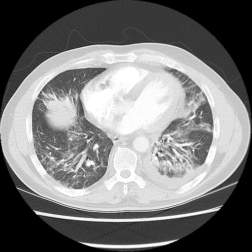 Acute epicardial fat necrosis (Radiopaedia 42327-45440 Axial lung window 38).jpg