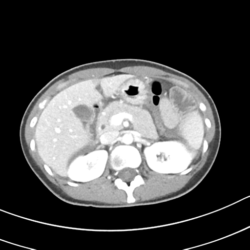 Acute gangrenous appendicitis with perforation (Radiopaedia 40152-42662 Axial C+ portal venous phase 21).png