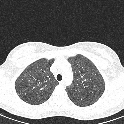 File:Acute hypersensitivity pneumonitis (Radiopaedia 85293-100870 Axial lung window 27).jpg