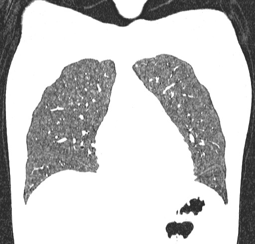 Acute hypersensitivity pneumonitis (Radiopaedia 85293-100870 Coronal lung window 32).jpg