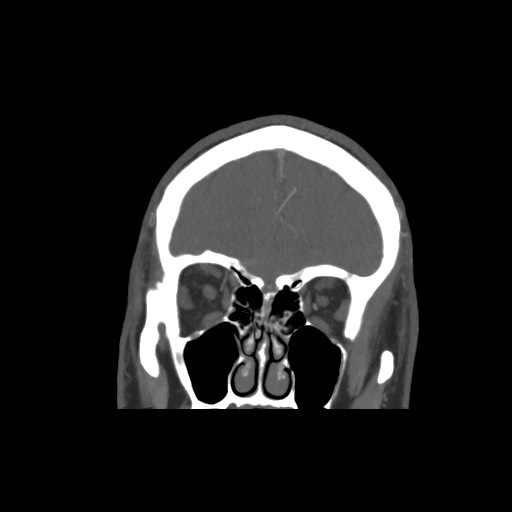 Acute internal carotid artery dissection (Radiopaedia 53541-59630 E 14).jpg