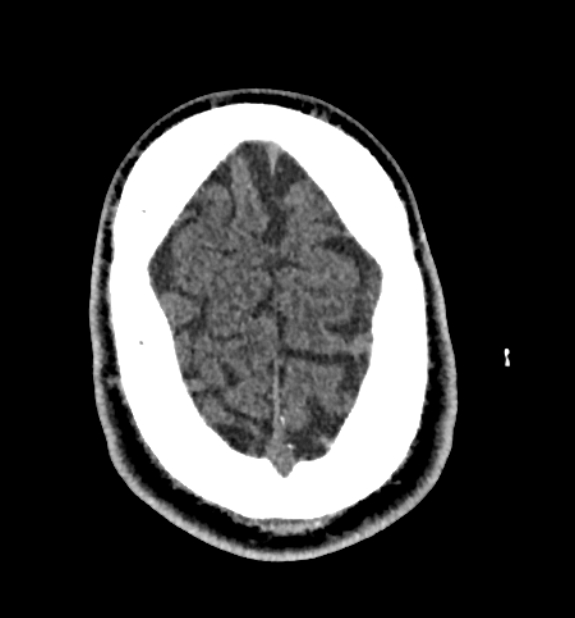 Acute ischemic stroke - posterior circulation territory (Radiopaedia 77670-89881 non-contrast 82).jpg