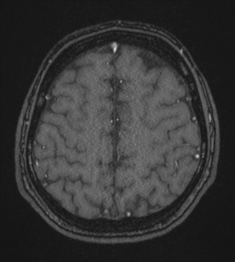 Acute left middle cerebral artery territory infarct with clot retrieval (Radiopaedia 47732-52433 Axial MRA 53).png
