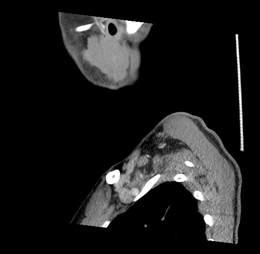 Acute longus colli calcific tendinitis (Radiopaedia 72495-83036 Sagittal C+ arterial phase 1).jpg