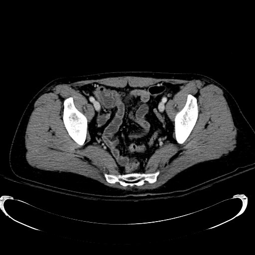 Acute myocardial infarction in CT (Radiopaedia 39947-42415 Axial C+ portal venous phase 114).jpg
