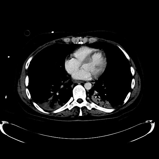 File:Acute myocardial infarction in CT (Radiopaedia 39947-42457 Axial C+ portal venous phase 1).jpg