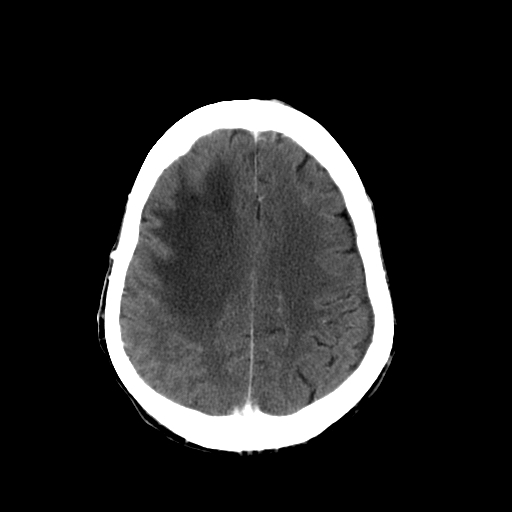 File:Acute necrotizing toxoplasma encephalitis (Radiopaedia 10683-11150 C+ arterial phase 10).jpg