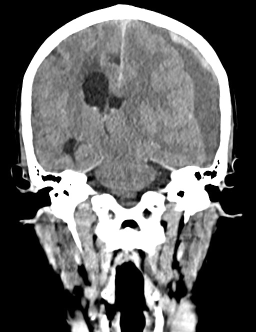 Acute on chronic subdural hematoma (Radiopaedia 74814-85823 Coronal non-contrast 38).jpg