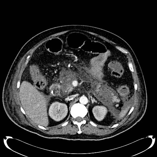 Acute pancreatic necrosis (Radiopaedia 13560-18500 Axial C+ portal venous phase 56).jpg