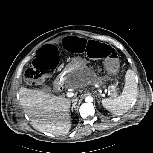 File:Acute pancreatic necrosis (Radiopaedia 13560-18502 Axial C+ portal venous phase 16).jpg