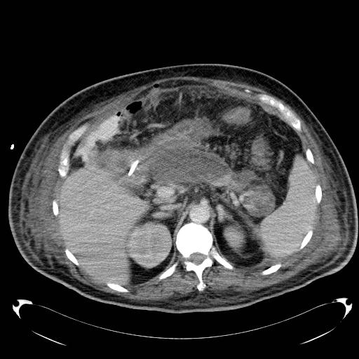 File:Acute pancreatic necrosis (Radiopaedia 13560-18503 Axial C+ portal venous phase 23).jpg