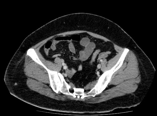Acute pancreatitis (Radiopaedia 69236-79012 Axial C+ portal venous phase 74).jpg
