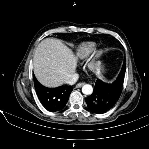 File:Acute pancreatitis (Radiopaedia 85146-100701 Axial C+ arterial phase 24).jpg