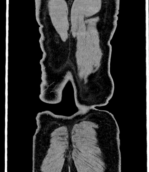 Acute pancreatitis (Radiopaedia 87428-103757 Coronal C+ portal venous phase 91).jpg
