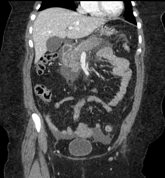 Acute pancreatitis - Balthazar E (Radiopaedia 29016-29377 Coronal C+ portal venous phase 39).png
